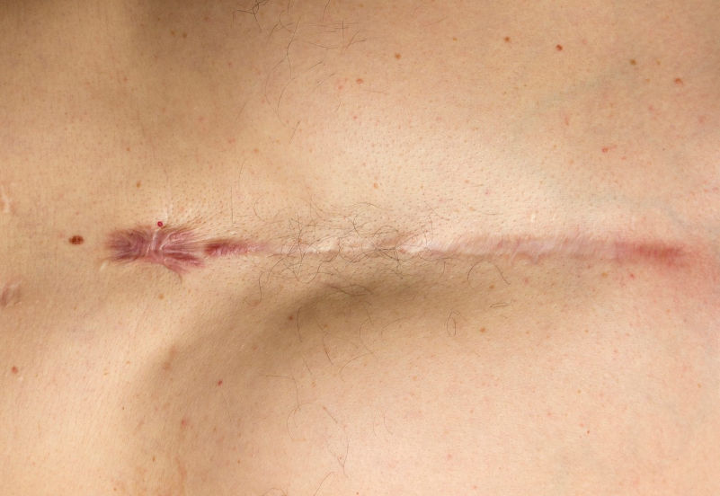 Scar Release